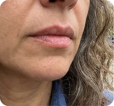 30 day LipFill results