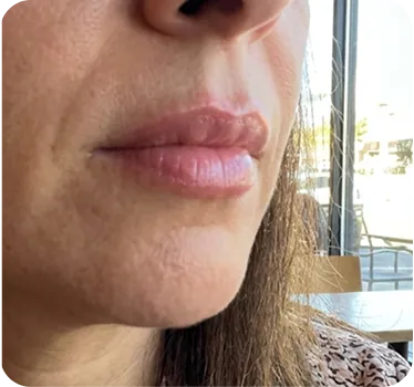 90 day LipFill results