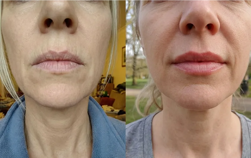 Kate LipFill results
