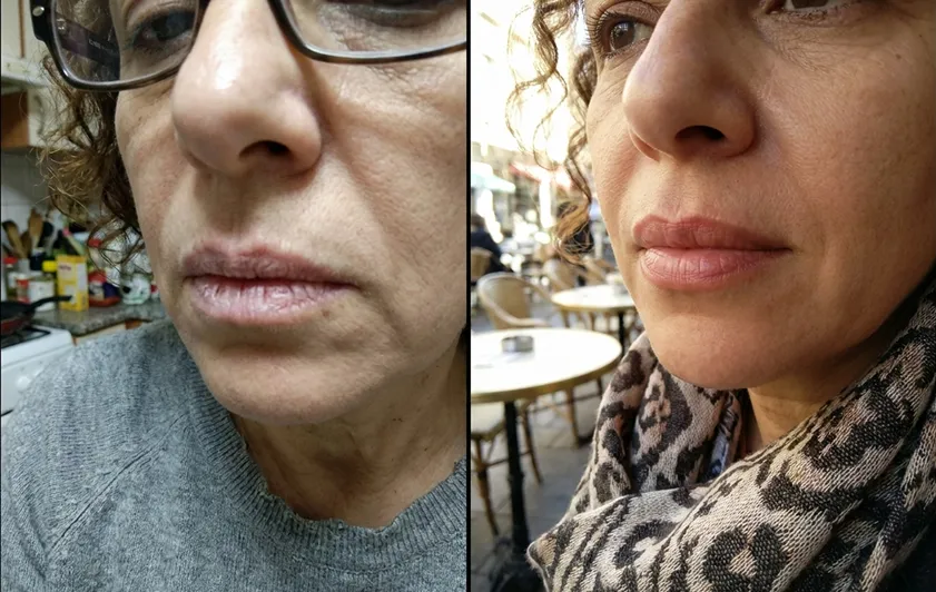 Jenn LipFill results
