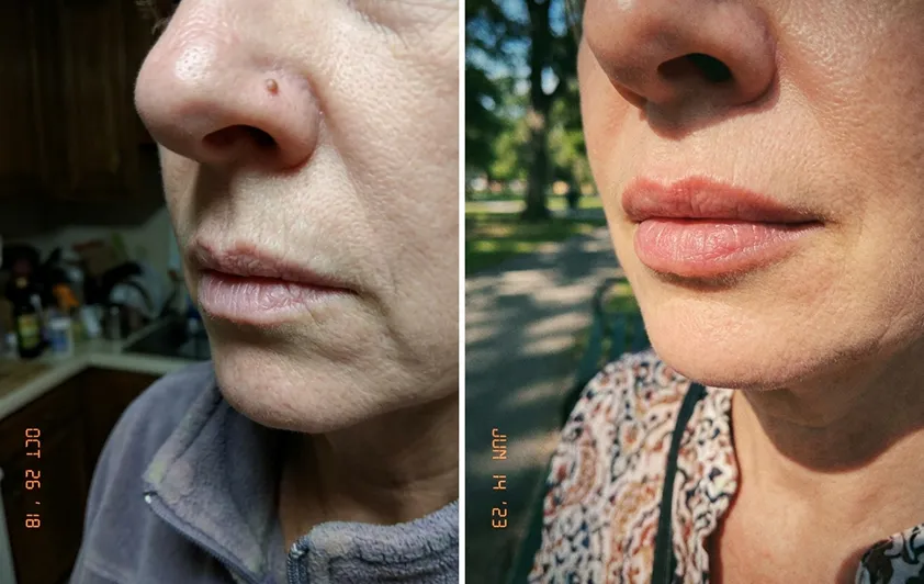 Lana LipFill results