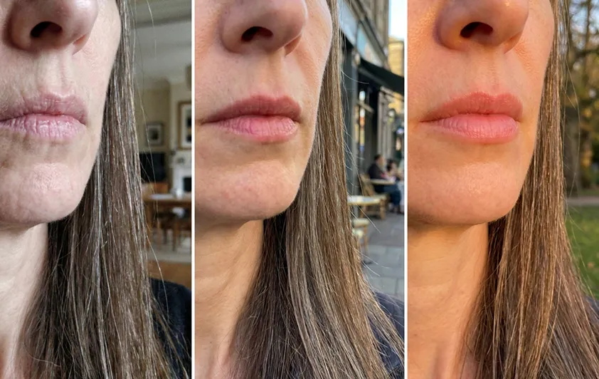 Julia LipFill results