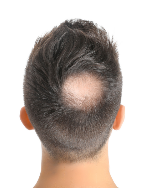 Thinning crown
